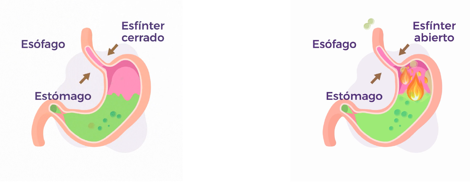 Comparación estómago normal vs ERGE